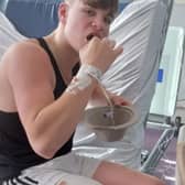 Ollie Hercombe, 16, snapped his leg spontaneously while sparring in a boxing gym and had to have his leg amputated.